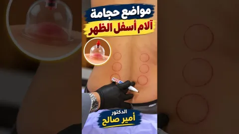 مواضع حجامة آلام أسفل الظهر