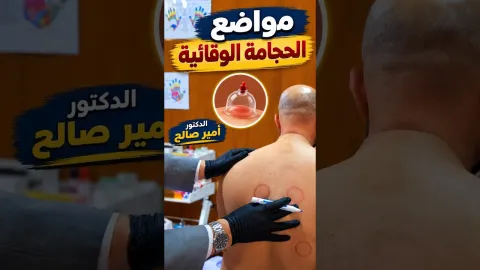 مواضع الحجامة الوقائية