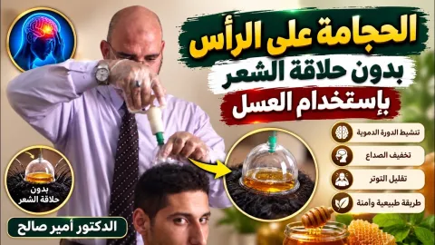 حجامة على اليافوخ أعلى الرأس بدون حلاقة الشعر باستخدام العسل